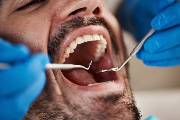 Best Emergency Dentist for Knocked-Out Tooth in Parole, MD
