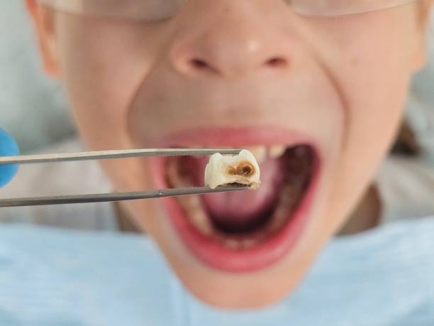 Best Emergency Dental Care for Abscessed Tooth in Parole, MD
